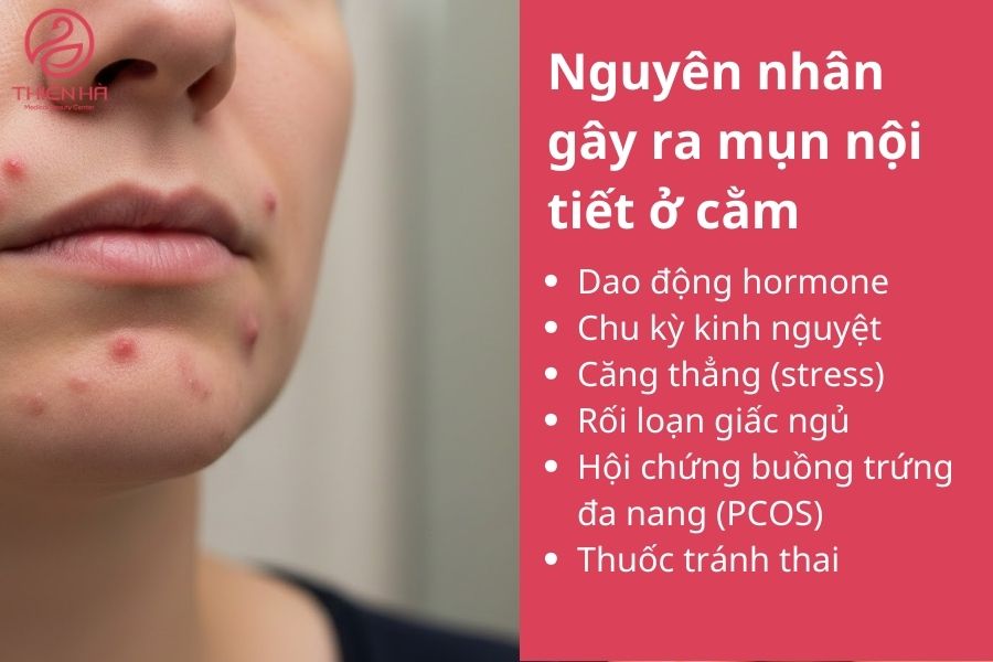 Nguyên nhân gây ra mụn nội tiết ở cằm 