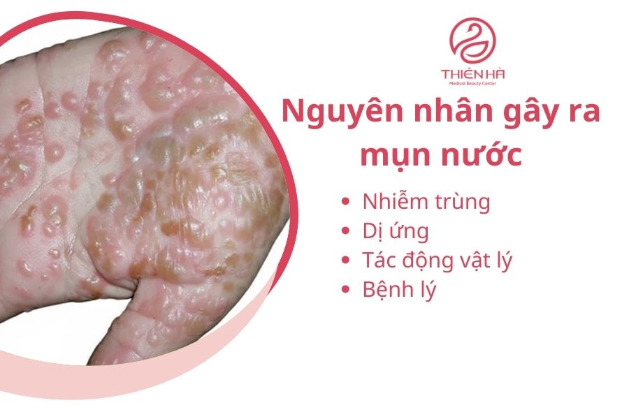 Nguyên nhân nào gây ra mụn nước ? 