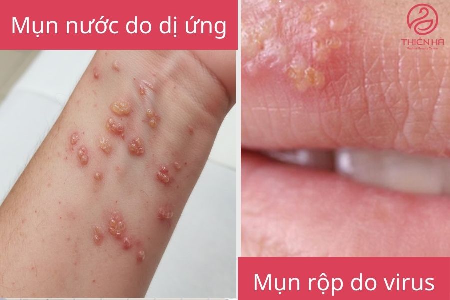 Các loại mụn nước thường gặp 