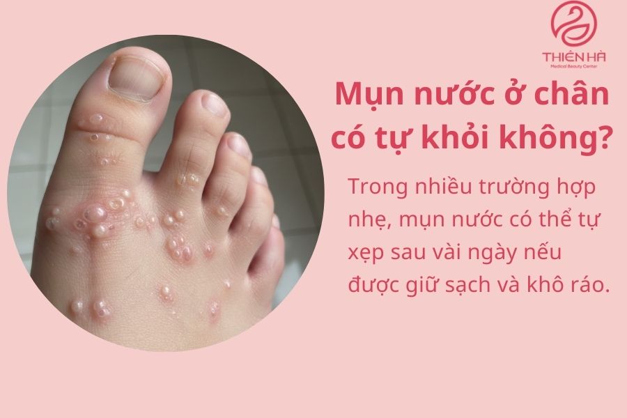 Câu hỏi thường gặp về mụn nước ở chân 