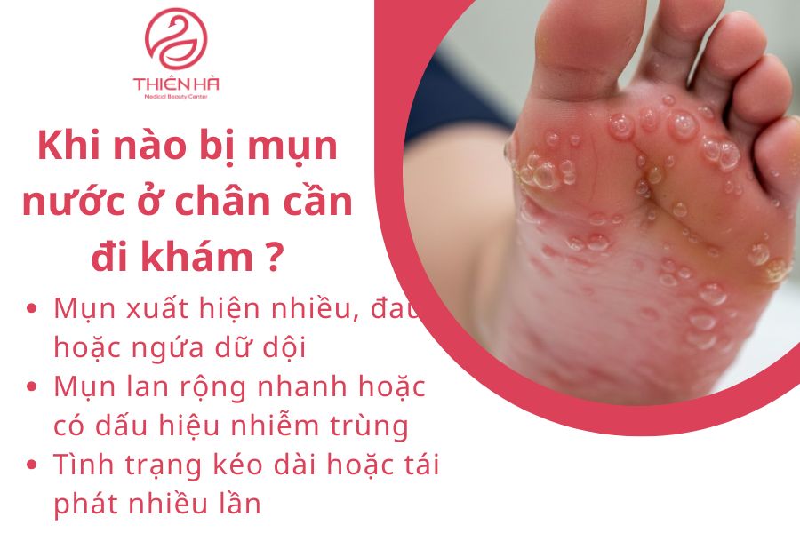 Khi nào bị mụn nước ở chân cần đi khám