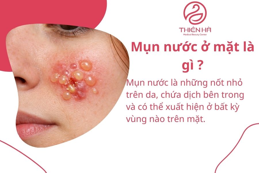 Tất tần tật về mụn nước ở mặt: Nguyên nhân, dấu hiệu & cách điều trị 1 Mụn nước ở mặt là gì ?