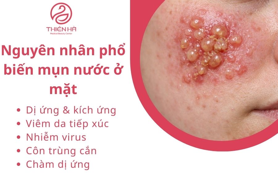 Tất tần tật về mụn nước ở mặt: Nguyên nhân, dấu hiệu & cách điều trị 2 Nguyên nhân phổ biến mụn nước ở mặt