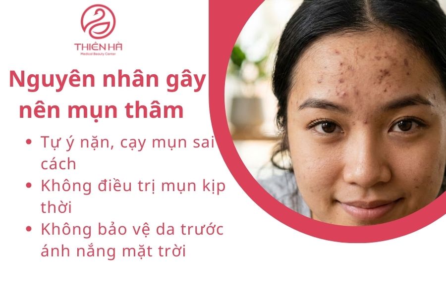 Nguyên nhân nào gây nên mụn thâm ? 