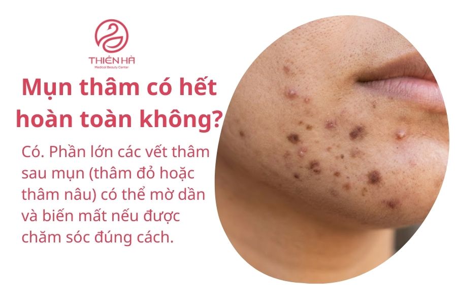 Mụn thâm có hết hoàn toàn không?