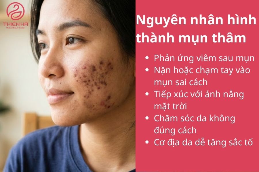 Nguyên nhân hình thành mụn thâm 