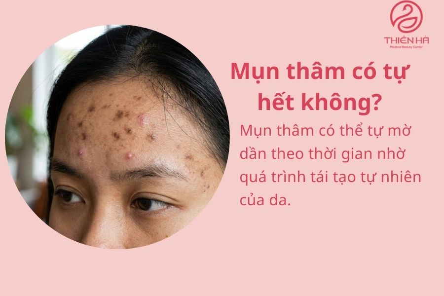 Mụn thâm có tự hết không? 