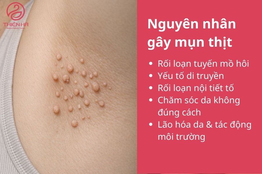 Nguyên nhân gây mụn thịt