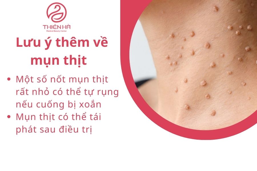 Lưu ý thêm về mụn thịt 