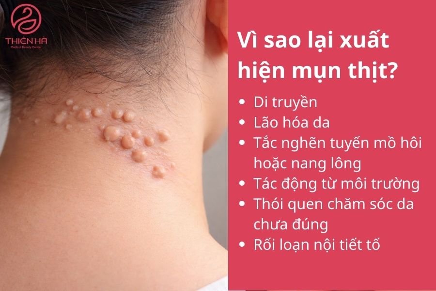 Vì sao lại xuất hiện mụn thịt?