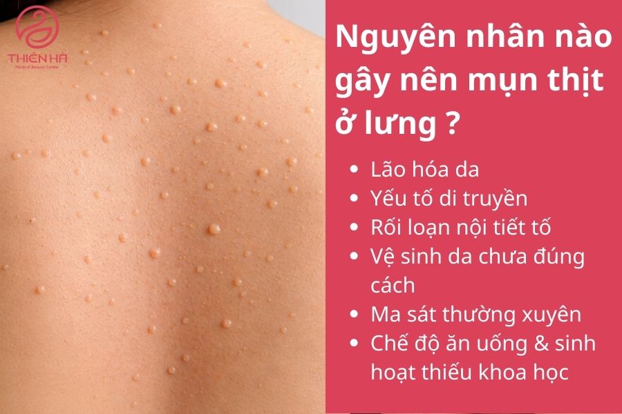 Nguyên nhân gây nên mụn thịt ở lưng 