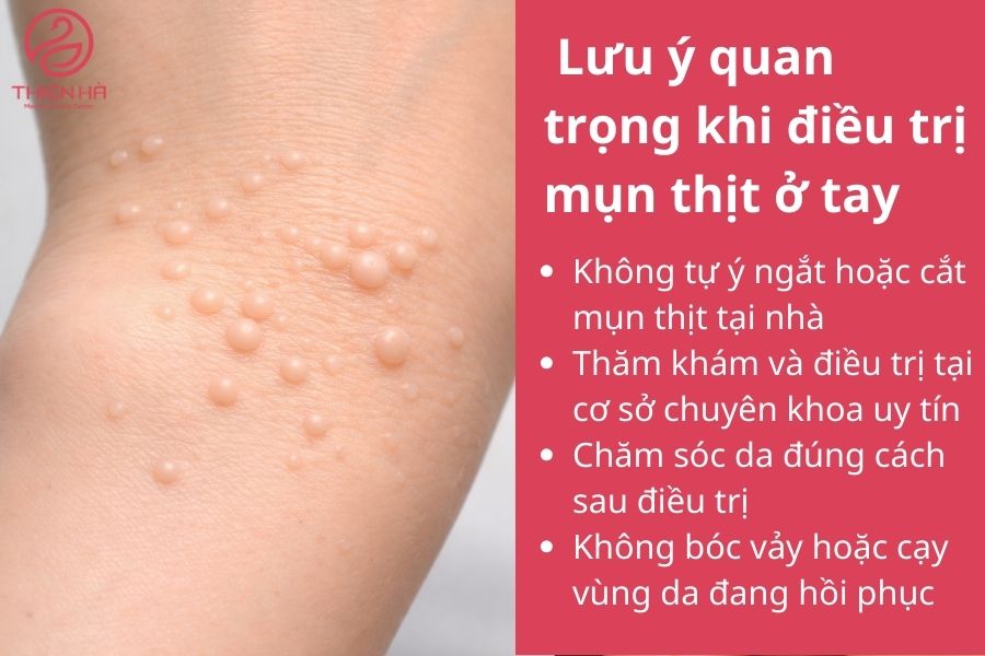 Lưu ý quan trọng khi điều trị mụn thịt ở tay