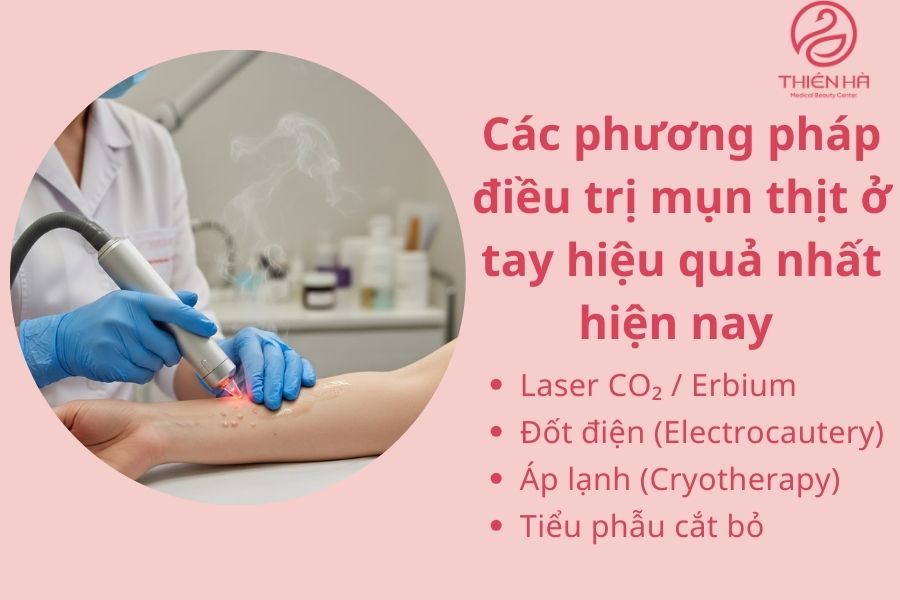 Các phương pháp điều trị mụn thịt ở tay hiệu quả nhất hiện nay 