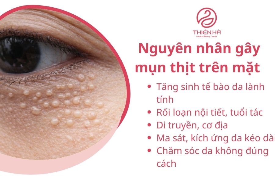 Nguyên nhân gây mụn thịt trên mặt 