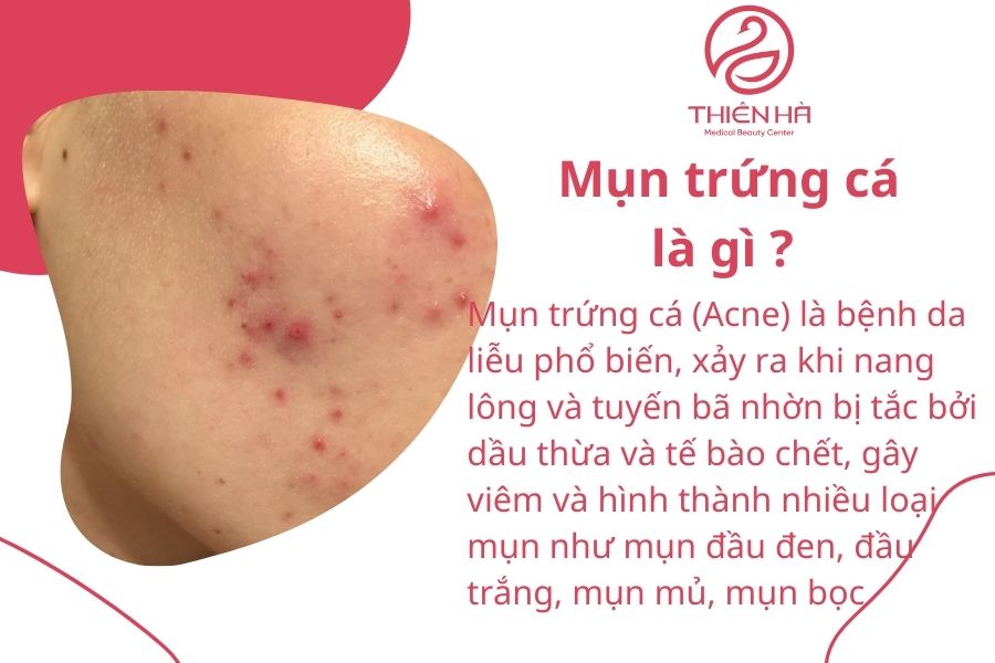 Mụn trứng cá là gì ? Mọi thông tin cần biết và cách điều trị hiệu quả 1 Mụn trứng cá là gì ?