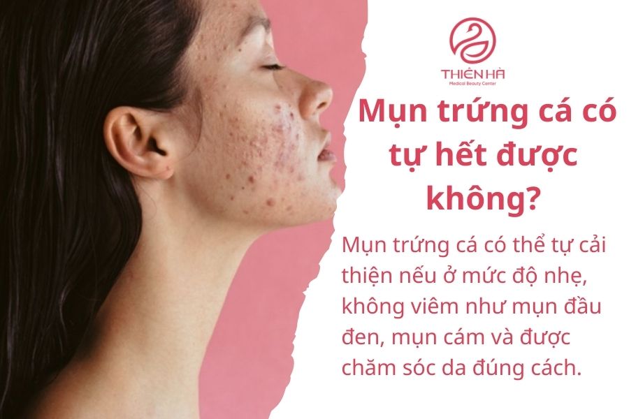 Mụn trứng cá là gì ? Mọi thông tin cần biết và cách điều trị hiệu quả 2 Mụn trứng cá có tự hết được không?
