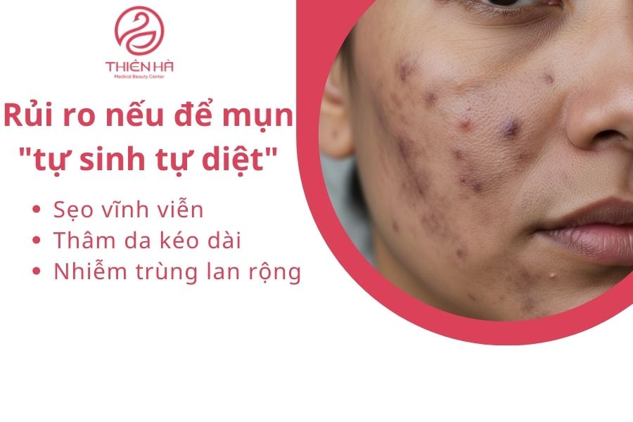 Rủi ro nếu để mụn "tự sinh tự diệt"