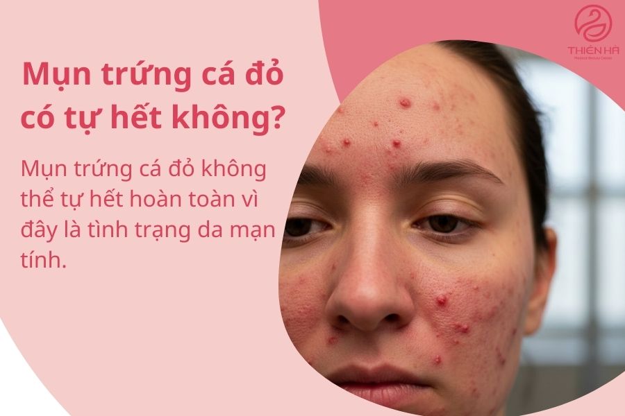 Mụn trứng cá đỏ có tự hết không?