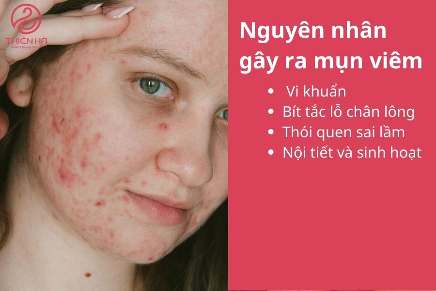 Nguyên nhân gây ra mụn viêm 