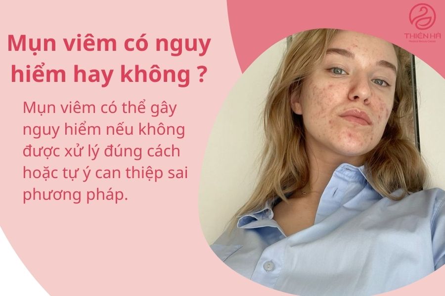 Mụn viêm có nguy hiểm hay không ?