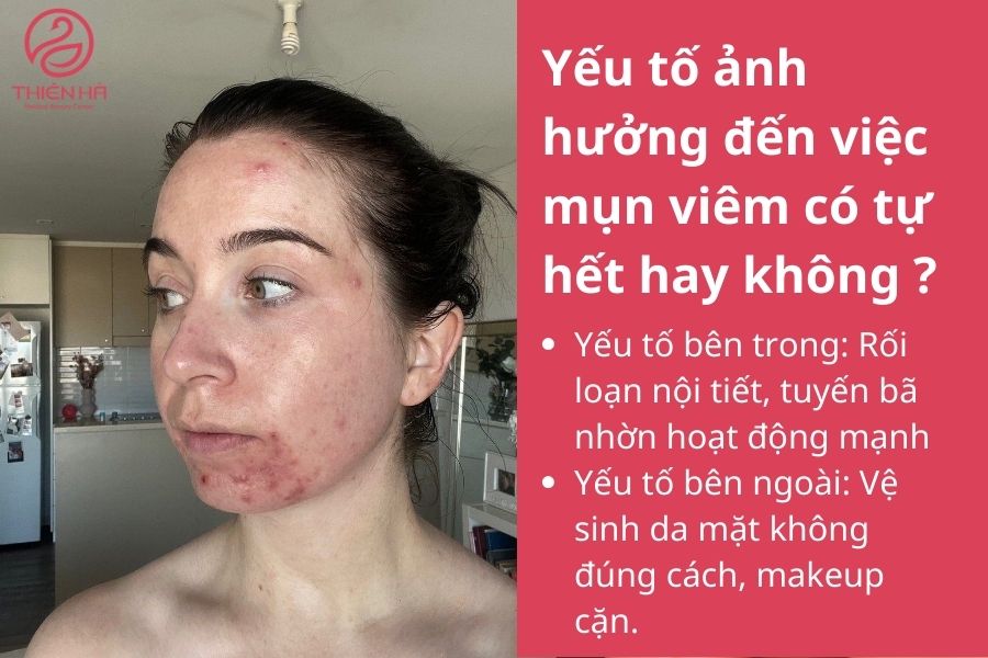 Mụn viêm có tự hết không? Khi nào cần điều trị để tránh thâm sẹo 1 Yếu tố ảnh hưởng đến việc mụn viêm có tự hết hay không ?