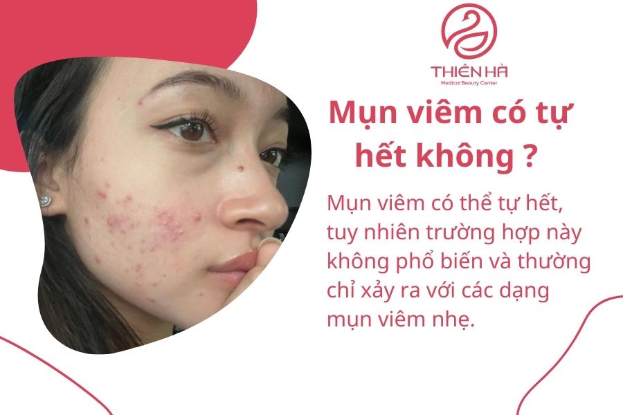 Mụn viêm có tự hết không? Khi nào cần điều trị để tránh thâm sẹo 2 Mụn viêm có tự hết không ?