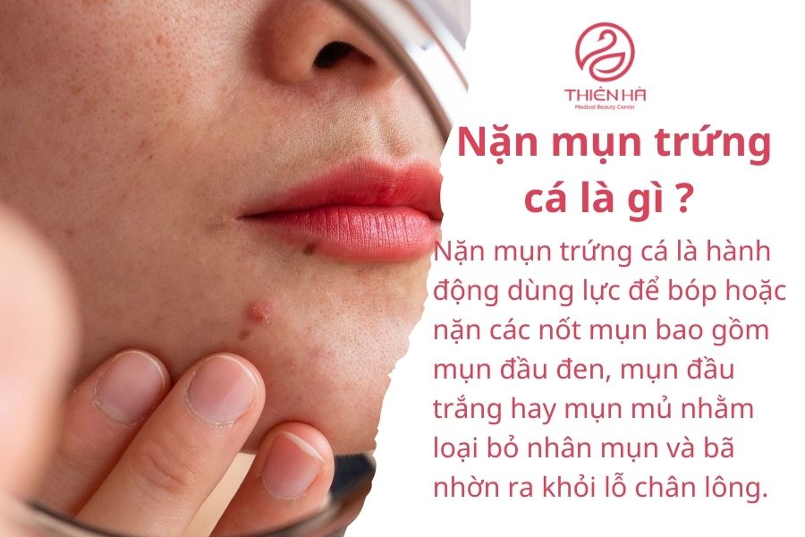 Nặn mụn trứng cá có nên không? Khi nào nặn an toàn cho da ? 1 Nặn mụn trứng cá là gì?