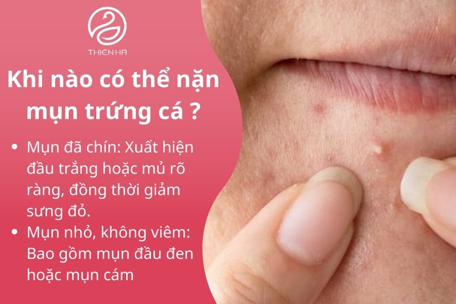 Nặn mụn trứng cá có nên không? Khi nào nặn an toàn cho da ? 3 Khi nào có thể nặn mụn trứng cá ?