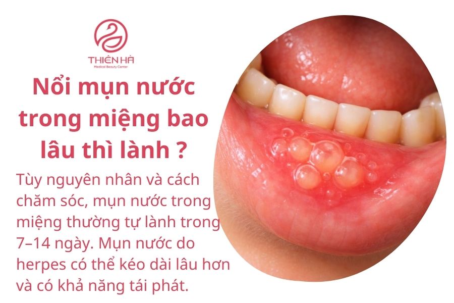 Nổi mụn nước trong miệng là gì ?