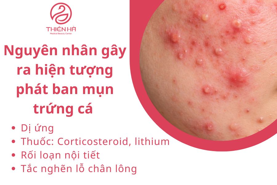 Nguyên nhân nào gây ra hiện tượng phát ban mụn trứng cá ? 