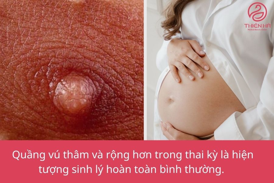 Quầng vú thâm rộng khi mang thai có bình thường không?