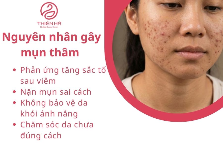 Nguyên nhân gây mụn thâm