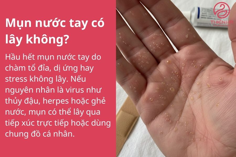 Tất tần tật về tay bị nổi mụn nước : Nguyên nhân và cách xử lý 5 Một số câu hỏi thường gặp khi tay bị nổi mụn nước