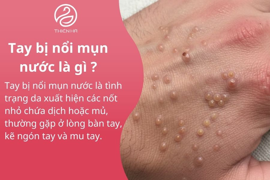 Tất tần tật về tay bị nổi mụn nước : Nguyên nhân và cách xử lý 1 Tay bị nổi mụn nước là gì ?