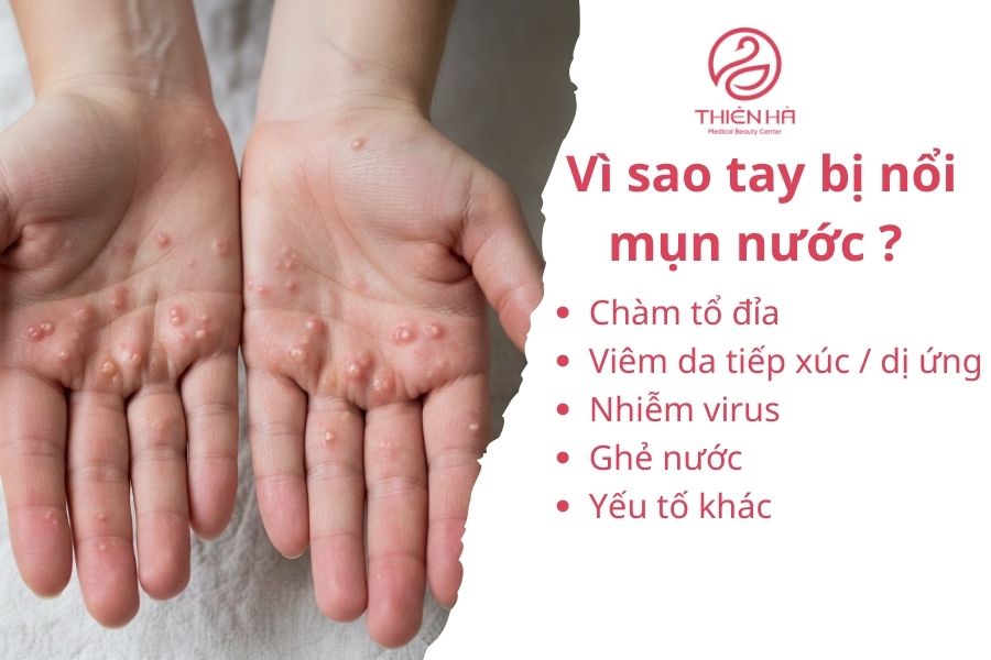 Tất tần tật về tay bị nổi mụn nước : Nguyên nhân và cách xử lý 2 Vì sao tay bị nổi mụn nước ?