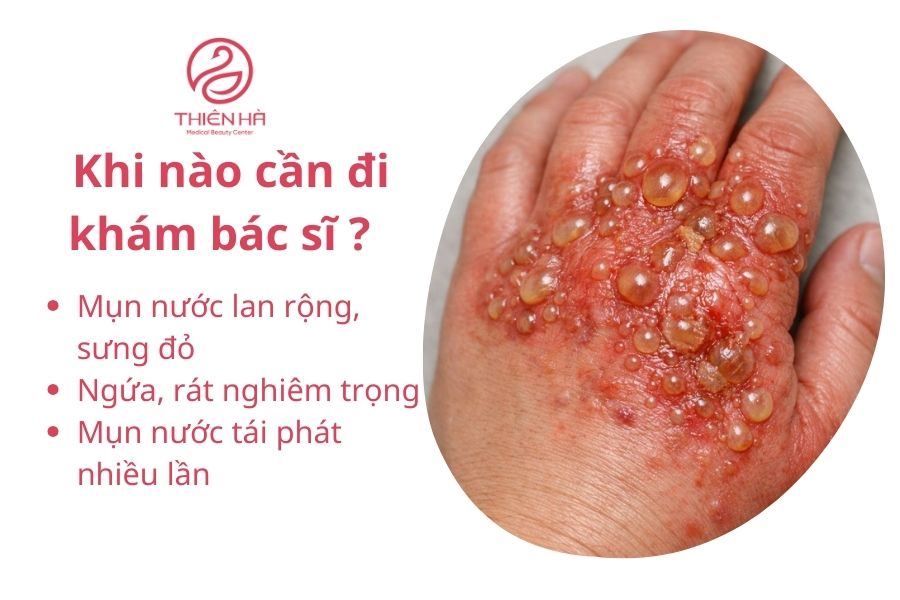 Tất tần tật về tay bị nổi mụn nước : Nguyên nhân và cách xử lý 4 Dấu hiệu cần đi khám bác sĩ