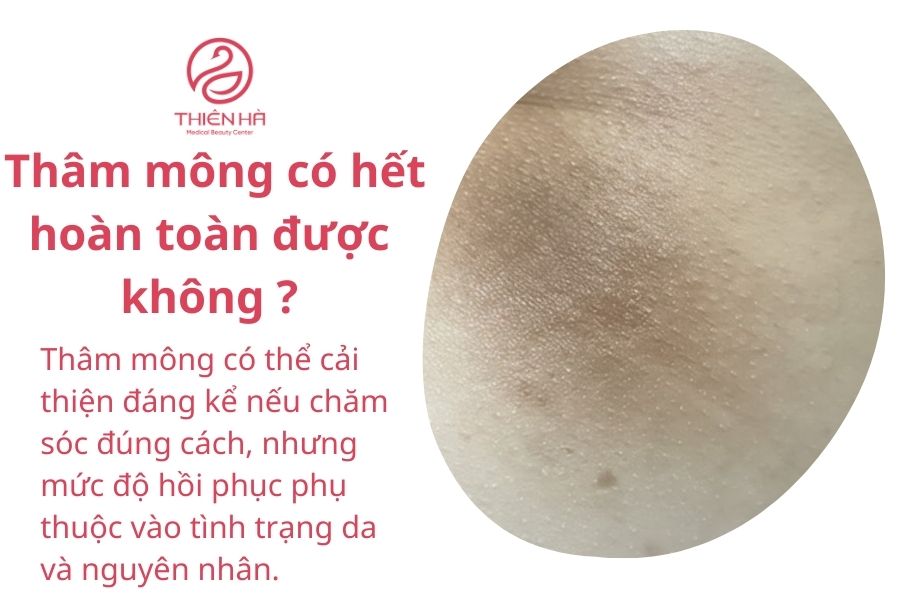 Một số câu hỏi thường gặp về thâm mông 