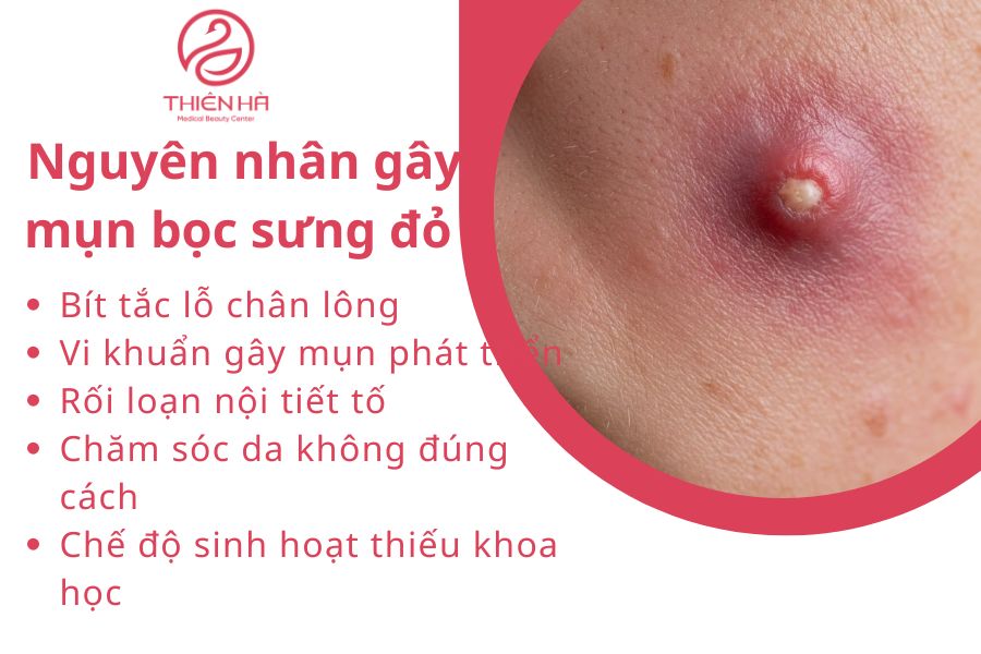 Nguyên nhân gây mụn bọc sưng đỏ