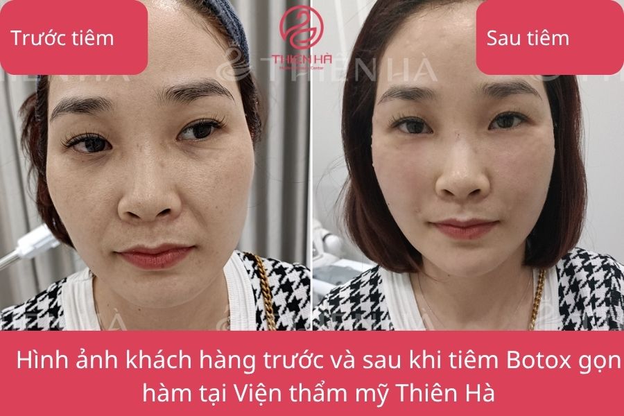 Kết quả tiêm Botox gọn hàm tại Thiên Hà
