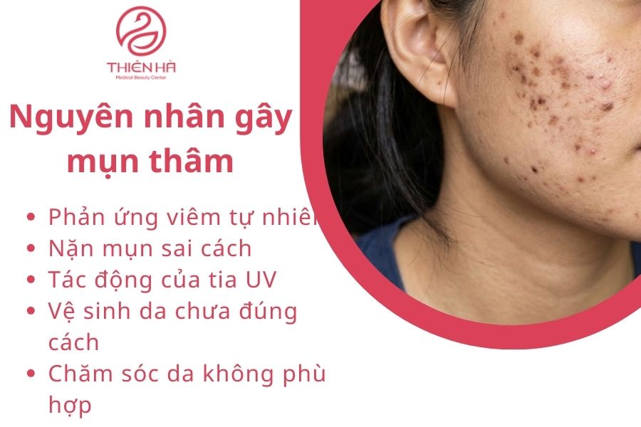 Nguyên nhân gây mụn thâm 