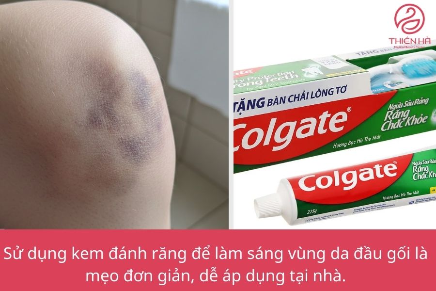 Trị thâm đầu gối bằng kem đánh răng: Hướng dẫn chi tiết, an toàn 1 Ưu – nhược điểm khi trị thâm đầu gối bằng kem đánh răng