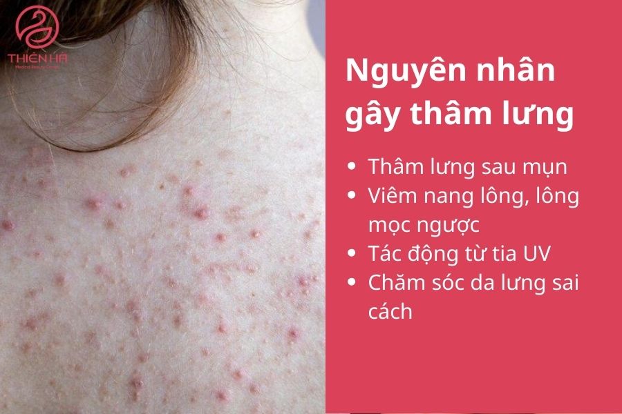 Nguyên nhân gây thâm lưng