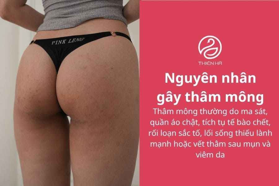 Trị thâm mông nhanh với Vaseline: 5 cách đơn giản tại nhà 1 Nguyên nhân gây thâm mông