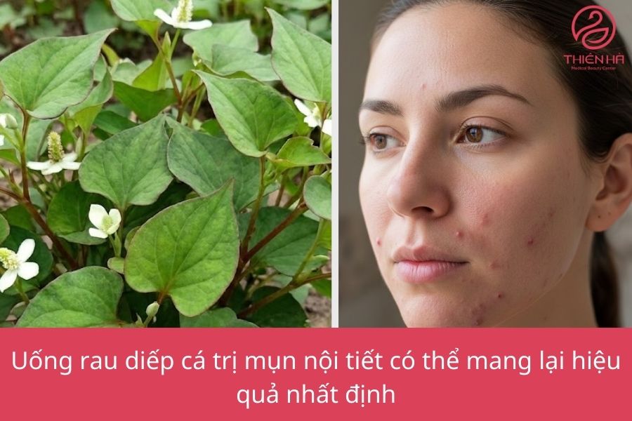 Uống rau diếp cá trị mụn nội tiết có thật sự hiệu quả không?