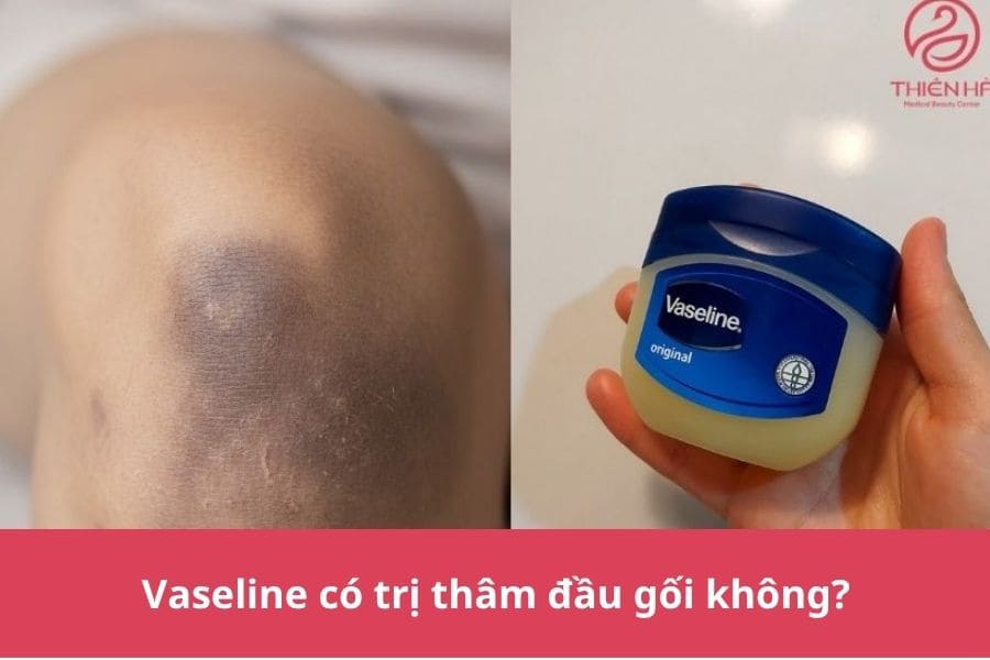 Giải đáp: Vaseline có trị thâm đầu gối không và cách sử dụng đúng 1 Vaseline có thể hỗ trợ cải thiện tình trạng thâm đầu gối nhờ khả năng dưỡng ẩm sâu và làm mềm lớp sừng, giúp da bớt khô ráp và đều màu hơn