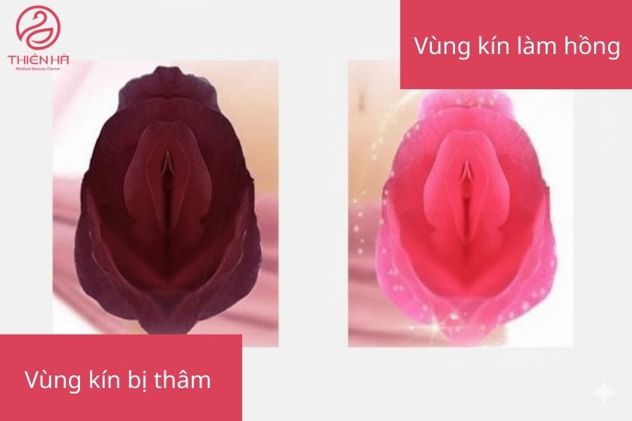 Nguyên nhân và cách cải thiện vùng kín thâm đen bẩm sinh an toàn 1 Hình ảnh vùng kín vị thâm đen và vùng kín làm hồng