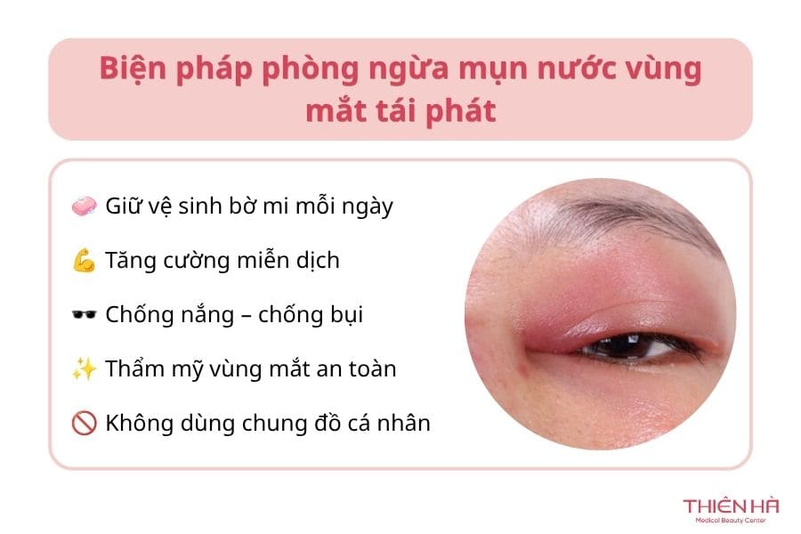 Mí mắt nổi mụn nước: Nguyên nhân thường gặp và cách xử lý đúng 10 Biện pháp phòng ngừa mụn nước vùng mắt tái phát
