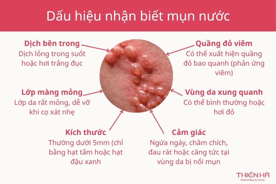 Mụn nước là gì? Dấu hiệu nhận biết mụn nước