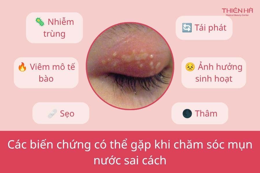 Biến chứng của mụn nước khi chăm sóc sai cách