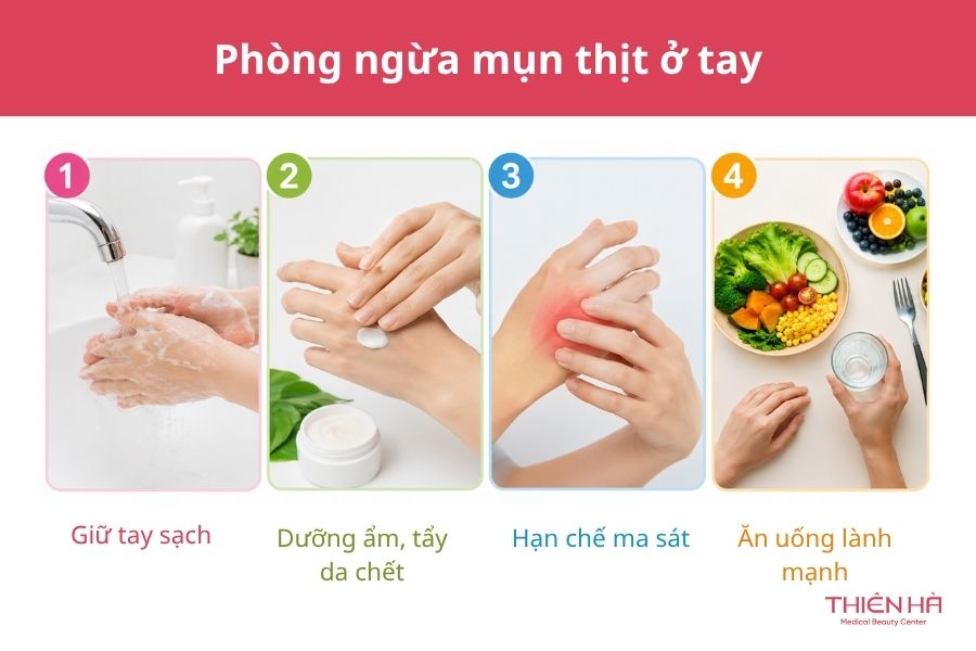 Mụn thịt ở tay: Nguyên nhân, cách nhận biết và phương pháp điều trị hiệu quả 6 Phòng ngừa mụn thịt ở tay